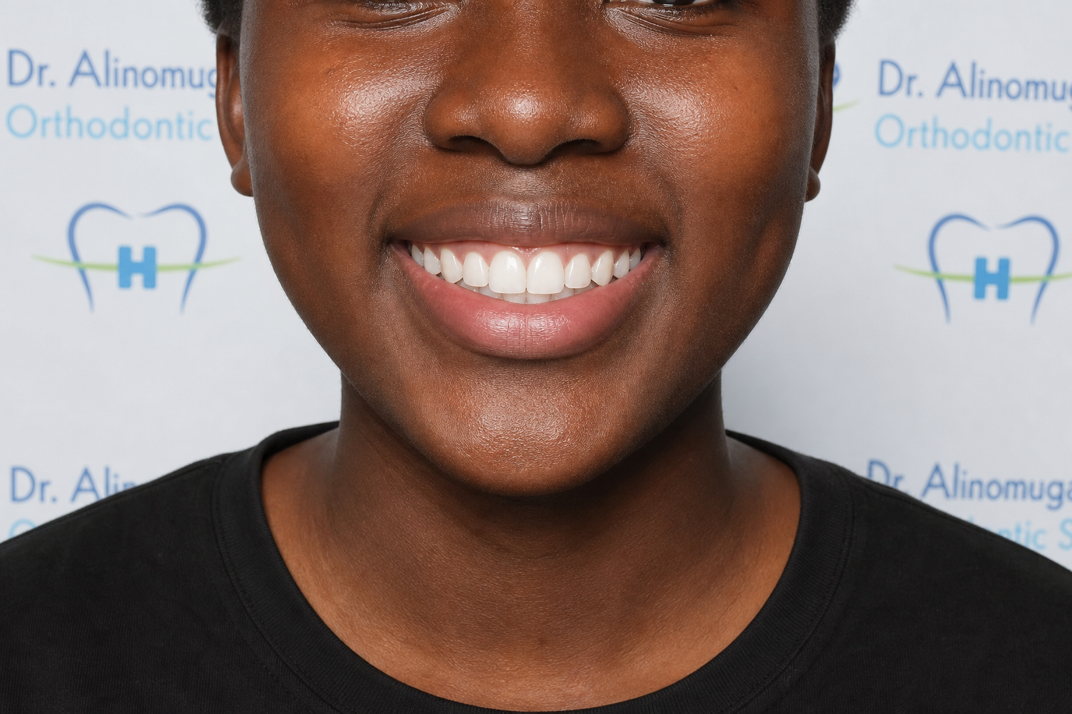Ceramic Braces Alignment — after
