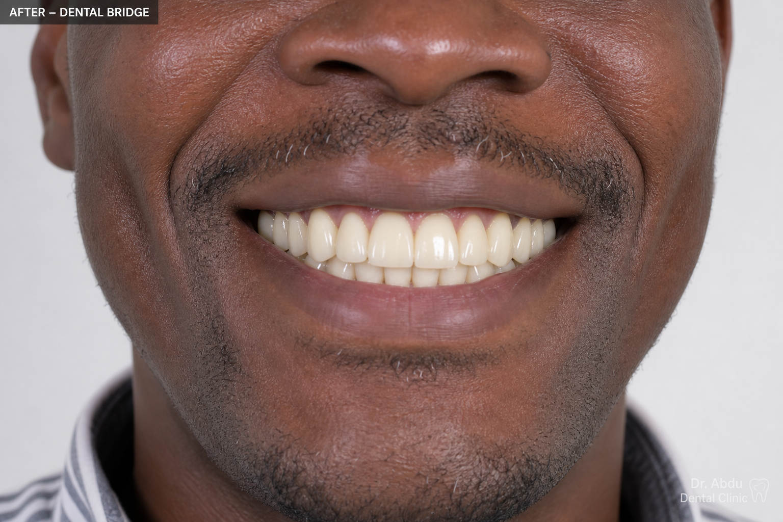 Implant-Supported Bridge — after