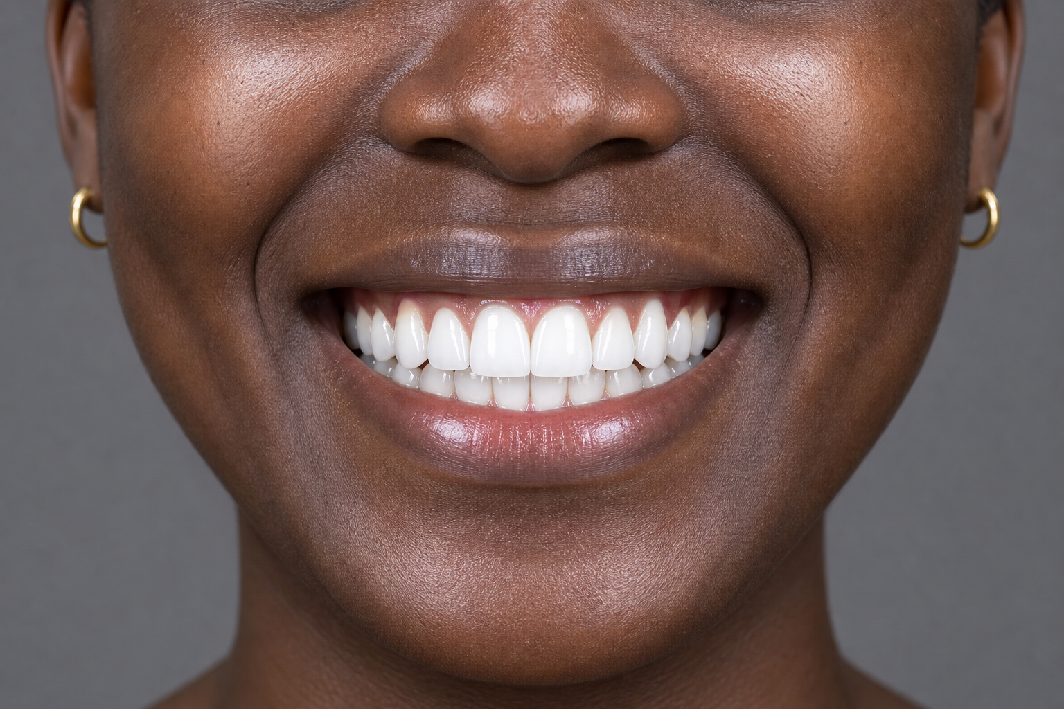 After — Professional Whitening