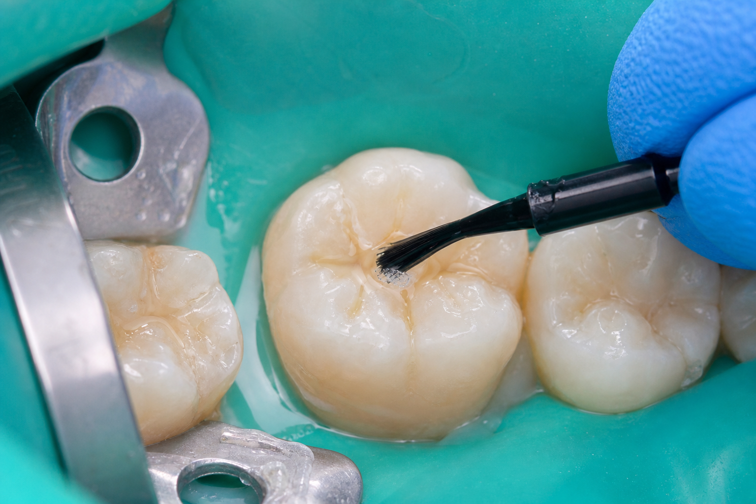 Shield back teeth from decay.